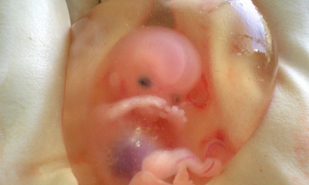 Zdjęcia ofiar aborcji