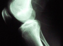 Zdjęcie rentgenowskie stawu kolanowego