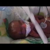 World’s Smallest Baby Born in San Diego at Sharp Mary Birch Hospital