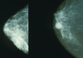 Ilu mammografom można zaufać?