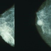 Ilu mammografom można zaufać?