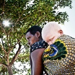 -letnia Asmura Msafili, albinoska z muzułmańskiej rodziny, z mamą
