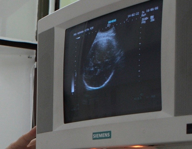 Przybywa zabitych po badaniach prenatalnych