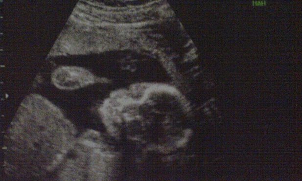 Zaproponowali aborcję, a dziecko się… uśmiechnęło