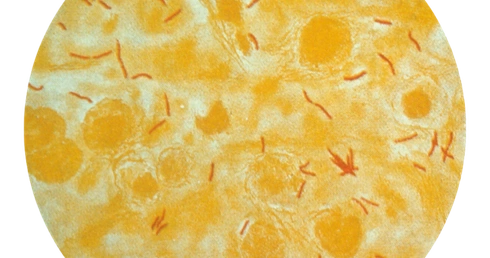 Lekarz: gruźlica nie zniknęła, wciąż diagnozujemy nowe przypadki