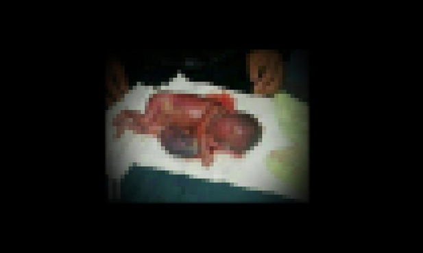 Aborcyjna makabra