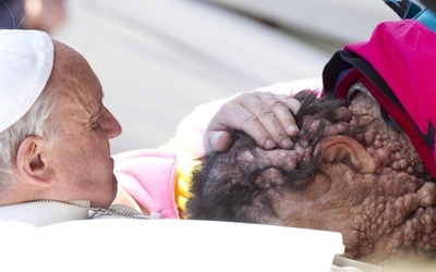 Papież przytulił człowieka o zdeformowanej twarzy