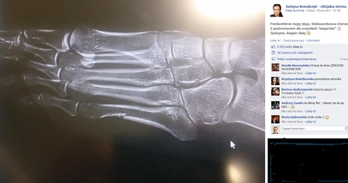 Szczegóły dot. złamania stopy Justyny Kowalczyk