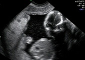 Wymowna data debaty nad zakazem aborcji eugenicznej