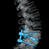 Zdjęcia rentgenowskie  kręgosłupa po repozycji i stabilizacji trzonów. Jego właścicielka zaczęła odzyskiwać sprawność już w drugiej  dobie po zabiegu