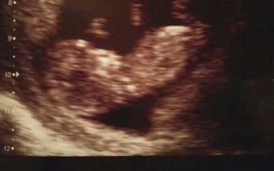 USG Jasia, synka Kingi i Daniela, w 11. tygodniu ciąży.