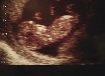 USG Jasia, synka Kingi i Daniela, w 11. tygodniu ciąży.