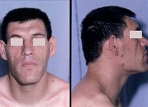 Charakterystyczne cechy akromegalii na twarzy
