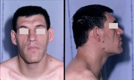 Charakterystyczne cechy akromegalii na twarzy