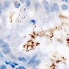 Helicobacter pylori wykryty metodą immunochemiczną