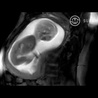 Incredible MRI Footage of a Baby in the Womb taken by iFIND Project