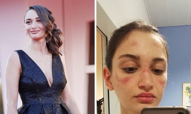Alessia po raz drugi trafiła na czołówki gazet jako symbol walki z koronawirusem.