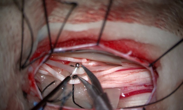 Katowice. Pomoc dla dzieci z porażeniem mózgowym. Zabiegi w Górnośląskim Centrum Zdrowia Dziecka