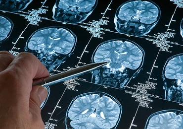 Przełom w leczeniu alzheimera?
