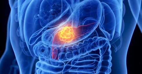 Od lat nie mieliśmy w raku trzustki takiego przełomu - mówi prof. Wyrwicz z Narodowego Instytutu Onkologii